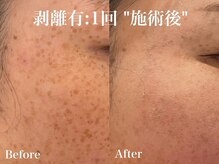 ヴィオール 名古屋栄店(VIOR)/シミ改善　ハーブピーリング