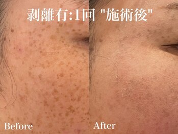 ヴィオール 名古屋栄店(VIOR)/シミ改善　ハーブピーリング