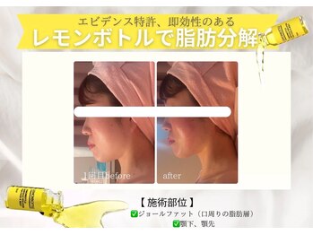 エステティックサロン フェアリー(ESTHETIC SALON FAIRLY)/小顔＊レモンボトル導入店