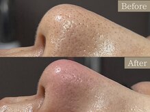 ティーツリー 名古屋 桜山(Tea Tree)/【毛穴ケア・毛穴洗浄】