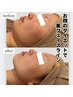 【charis小顔施術＋金の糸脱毛＋陶器肌パック】肩コリ、デコルテ、背中ほぐし