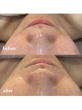 リモアボーテ(RIMOA beaute)/【毛穴】before→after