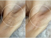 アンベリール(Embellir)/男性ワックス脱毛