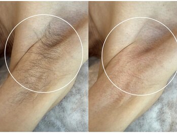 アンベリール(Embellir)/男性ワックス脱毛