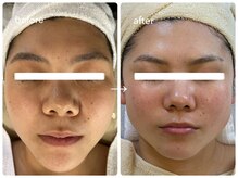 ナポデイズ(NAPODAYS)/鼻の毛穴詰まり(全顔ザラつき)