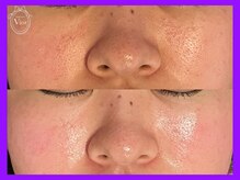 ヴィオール 名古屋栄店(VIOR)/光フェイシャル