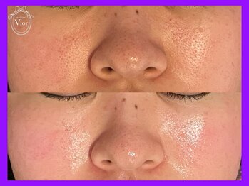 ヴィオール 名古屋栄店(VIOR)/光フェイシャル
