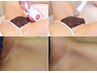 エステ唯一【美療VIO脱毛＋色素ケア】圧倒的な抜け＋美容メソ導入のW改善