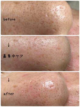 ルームエイトエイティスリー 新宿(R883)/毛穴スッキリ改善コース