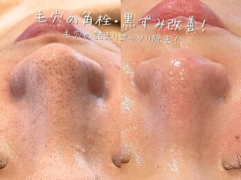 エヌエースキン 武蔵小杉店(Naskin)/毛穴汚れをスッキリ！