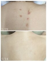 ラミーユ(La Miu)/背中ハーブ４回目アフター