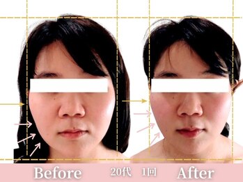 アメリイ 百合ヶ丘 新百合ヶ丘(Amerii)/小顔1回20代韓国アイドル小顔に