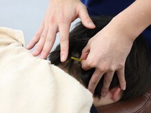 サンライズ鍼灸整骨院 川西院/肩こり徹底ケア