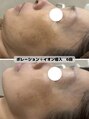 フォルチェ ゆめタウン広島店(Folche) ポレーションとイオン導入6回の変化です!