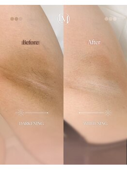 オアシス 吉祥寺(Oasis)/黒ずみケアのルメラ・ボディ部位