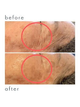 ソラ(Sora)/目尻のシワにアプローチ