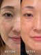 インディバサロン ド メイリィチィフゥア(indibasalon de meiliqihua)の写真/【極上エイジングケア】インディバ＆ウィッシュプロ70分◆大人肌のハリ・ツヤ・小顔にアプローチ！