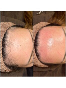 エースタイル(A-style.)/おでこ☆シュガーリング脱毛