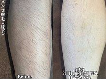 インク(ink)/メンズ　脱毛