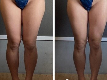 リジュ(Reju)/ハイパーナイフEX＋シェイプ痩身