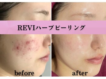 エステレア(Esthelea)/【REVI】ハーブピーリング