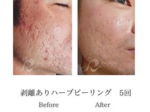 メンズミーシェ(Men's Meshie)/リベルハーブピーリング