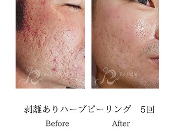 メンズミーシェ(Men's Meshie)/リベルハーブピーリング