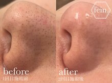 フェイン 青山店(fein.)/毛穴の黒ずみお掃除！