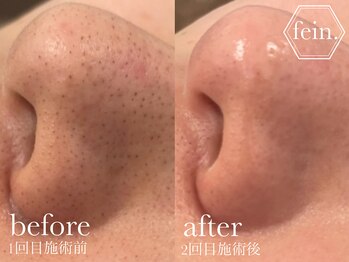 フェイン 青山店(fein.)/毛穴の黒ずみお掃除!