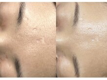 モガナ(mogana)/30代・きめ細かくフラットなお肌