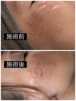 ウルト アルティメイトスキン(ULT ultimate skin)/最新シミケア