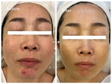 ナポデイズ(NAPODAYS)/繰り返すあごニキビケア