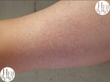 ハーバリー ハーブピーリング 岐阜(HERBERRYハーブピーリング)/ノースリーブで気になる二の腕