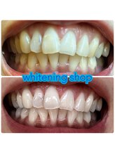 ホワイトニングショップ 久留米店(WHITENING SHOP)/ビフォーアフター