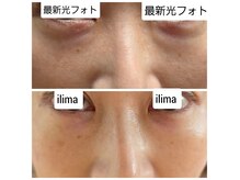 イリマ(Ilima)の雰囲気（最新光フォトトーニング）