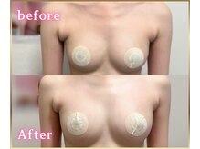 ジュエルリング(Jewel Ring)/症例写真バストアップ