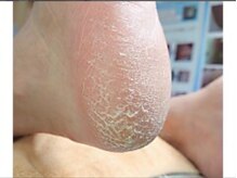 巻き爪補正店 姫路店/角質ケア