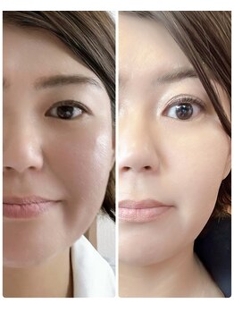 ルキア(LUKIA)/小顔【リフトアップ】施術２回