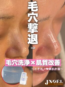 ジェノール 2nd beauty studio 姫路駅前店(JNOEL)/毛穴撃退！JNOEL肌質改善
