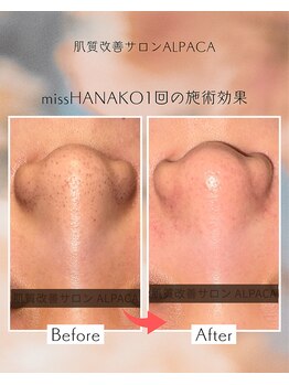 アルパカ(ALPACA)/missHANAKO