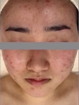カプロ ボゥ(Capullo.Beau)の写真/『その肌悩み、諦めないで！』医療提携サロンだから出来る！根本肌質改善◆大人ニキビケアの特化サロン◎