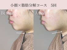 ミア(miiia)/小顔×脂肪分解コース　5回