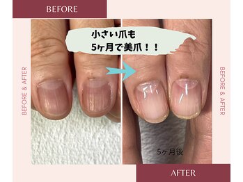 ブルームブルーム(BLOOMブルーム)/小さい爪も縦長美爪に！！