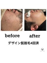 プライベートサロン コットン(COTTON)/ヒゲ脱毛