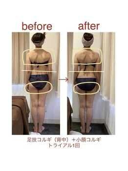 レアフィート(Rheafeet)/トライアル１回の症例写真