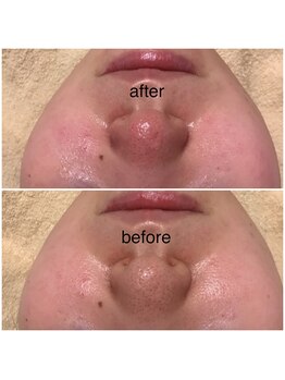 ココ(coco)/いちご鼻でお悩みの方必見☆