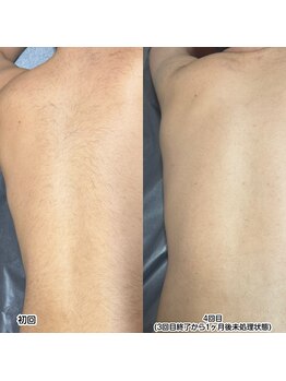 アピール(Appeal)/【光脱毛】自己処理が難しい背中