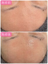 サロンドエテ(salon de ete)/ツヤ玉製造ハーブピーリング