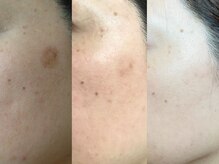 スターラッシュ 脱毛とハーブピーリングのプロ(Star Lash)の雰囲気（しみケア/ニキビケア/毛穴/敏感肌/お悩みご相談ください◎）