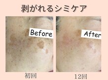 ウィズマツオカ 菊池本店/シミケア効果写真